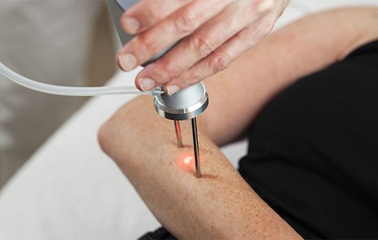 Venentherapie mittels Laser