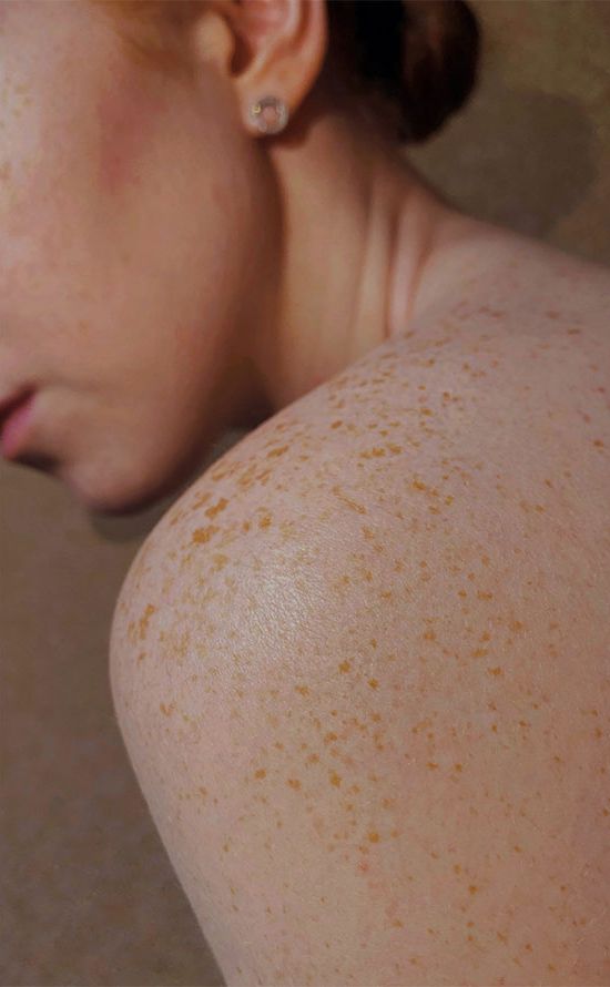 Pigmentflecken, Tattoos, Permanent Make-up Pigmentflecken, Tattoos, Permanent Make-up