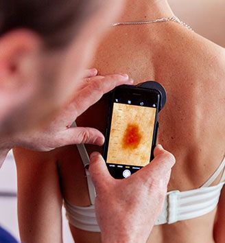 Hautkrebssceening Hautarzt Oberland