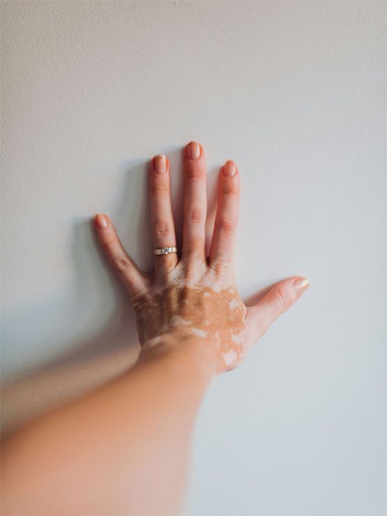 Ekzemerkrankungen, Alopecia Areata, Vitiligo Ekzemerkrankungen, Alopecia Areata, Vitiligo