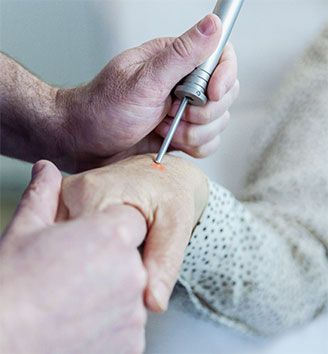 Laserbehandlung Altersfelcken Handrücken Laserbehandlung Altersfelcken Handrücken