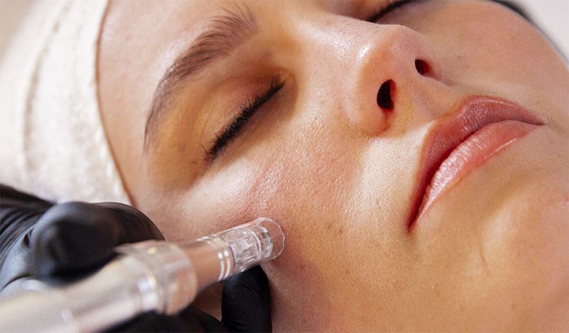 Mikrodermabrasion