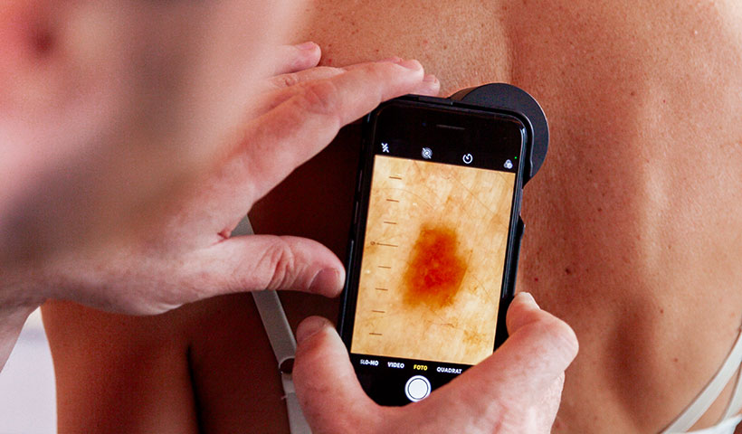 Checkup Box Hautkrebsscreening