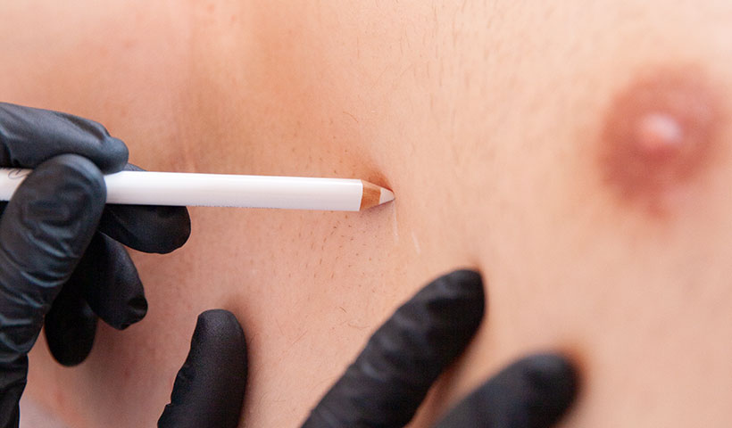 Übermäßiges Schwitzen