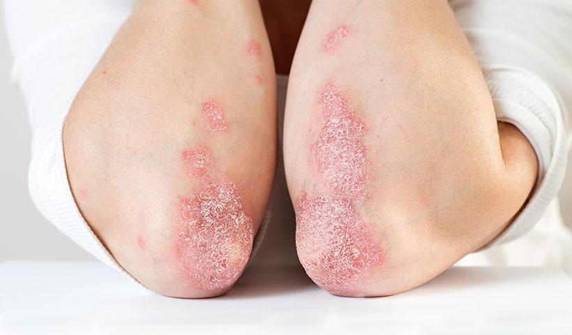 Psoriasis Hautarzt Oberland